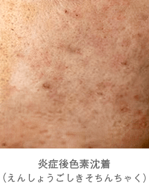 炎症後色素沈着